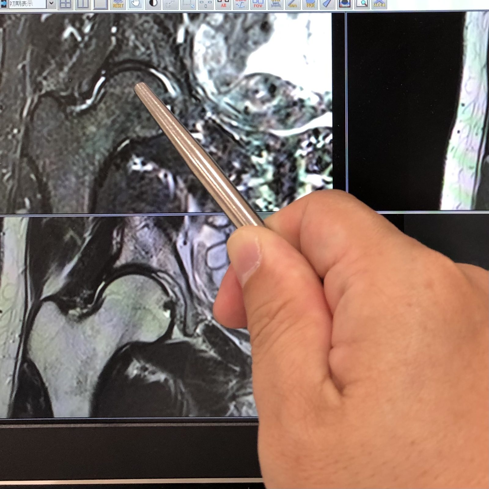 股関節のMRI検査の例