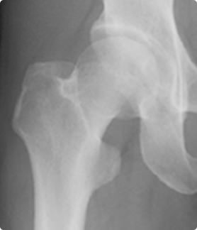 正常な股関節のレントゲン写真