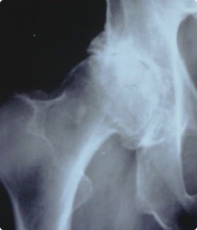 変形性股関節症のレントゲン写真
