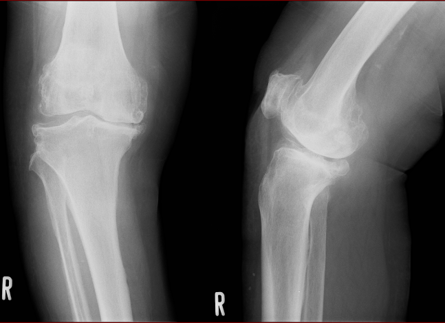 変形性膝関節症の手術前のレントゲン写真