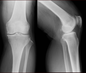 変形性膝関節症の手術前のレントゲン写真