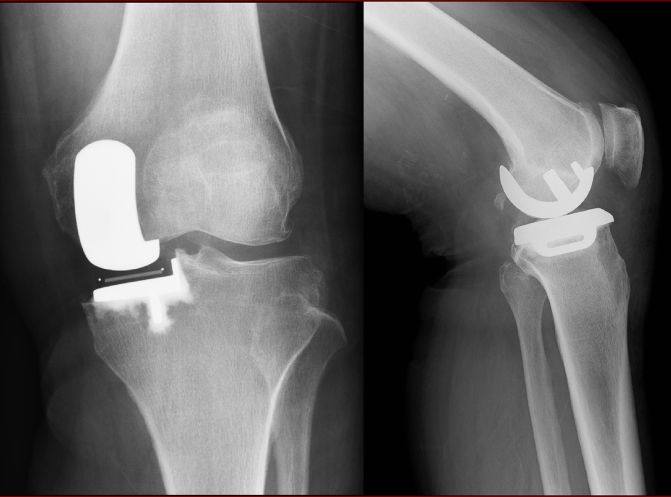 変形性膝関節症の手術後のレントゲン写真