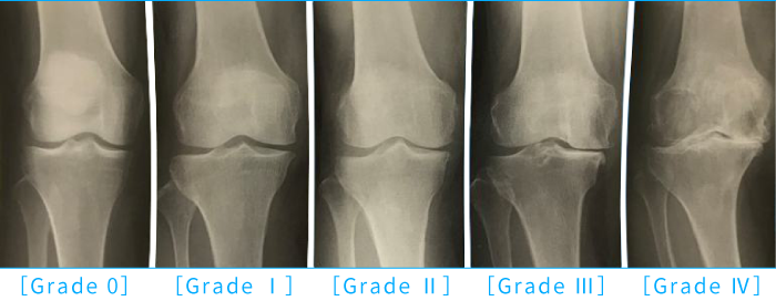 変形性膝関節症の5段階の分類の解説図