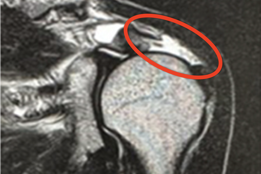 腱板断裂のレントゲン写真
